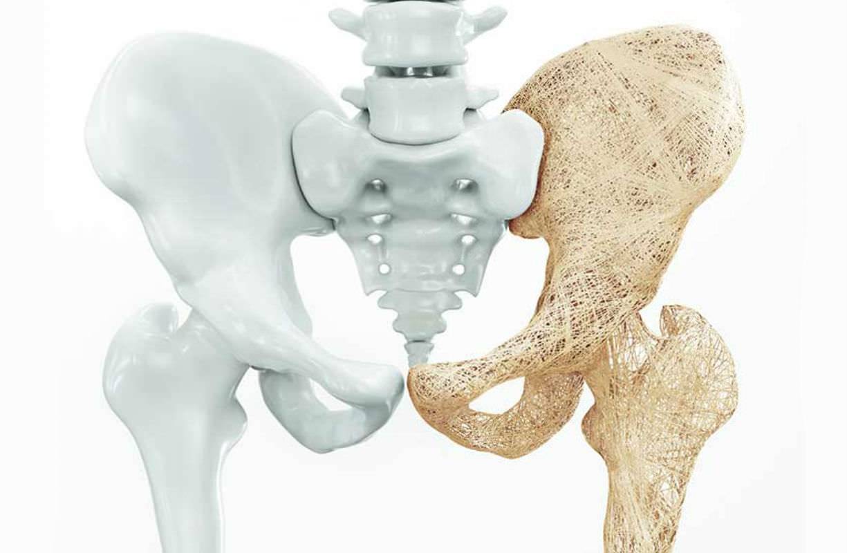 Osteoporosi, riconoscere i primi sintomi